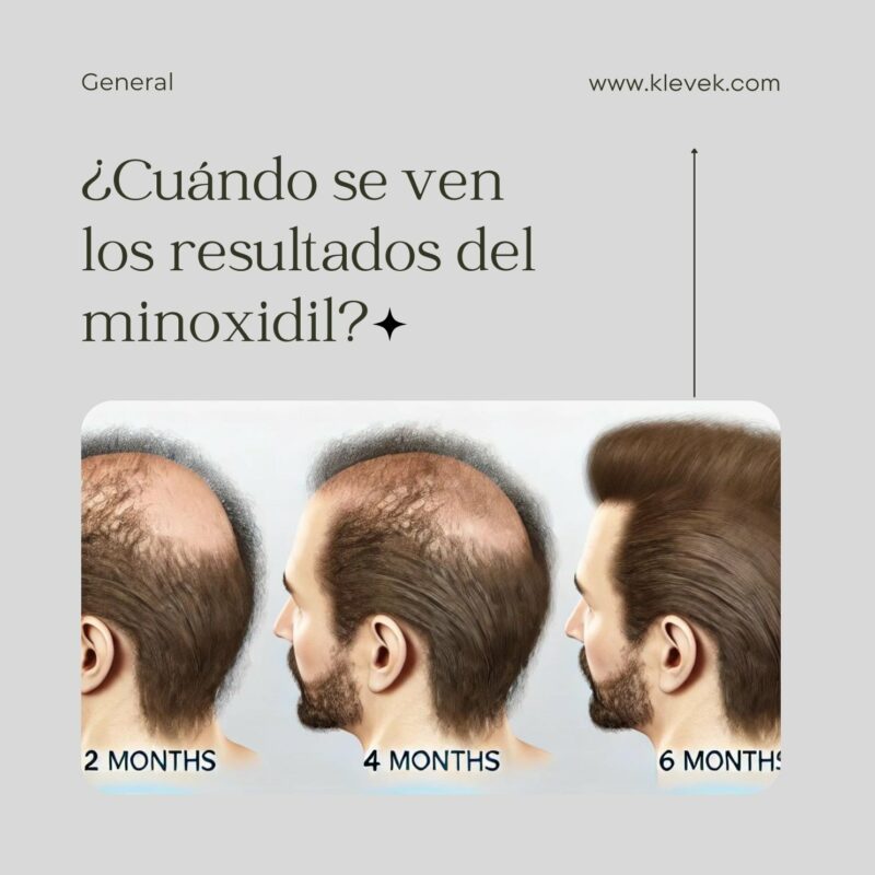 Cuando se ven los resultados del minoxidil